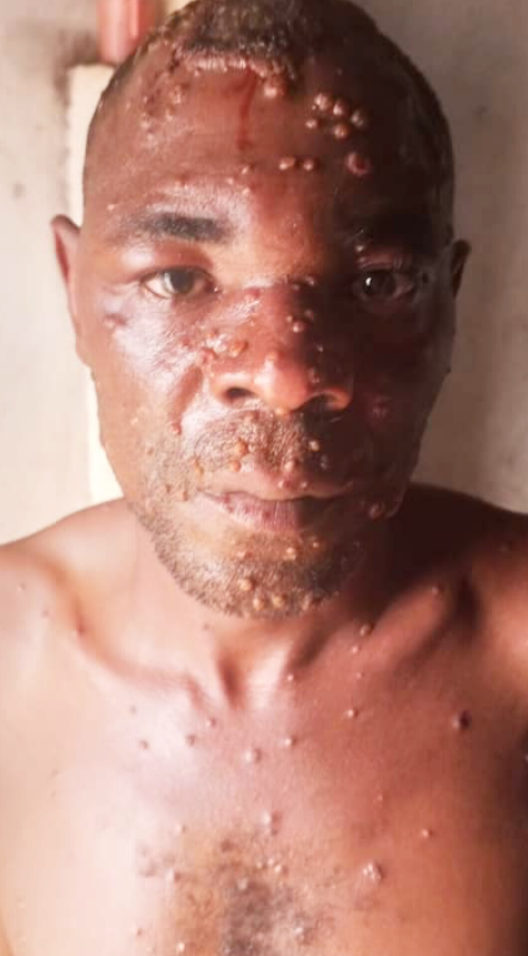 Kasaï : un cas suspect de Mpox signalé à Luebo, la Société civile appelle à renforcer la surveillance sanitaire